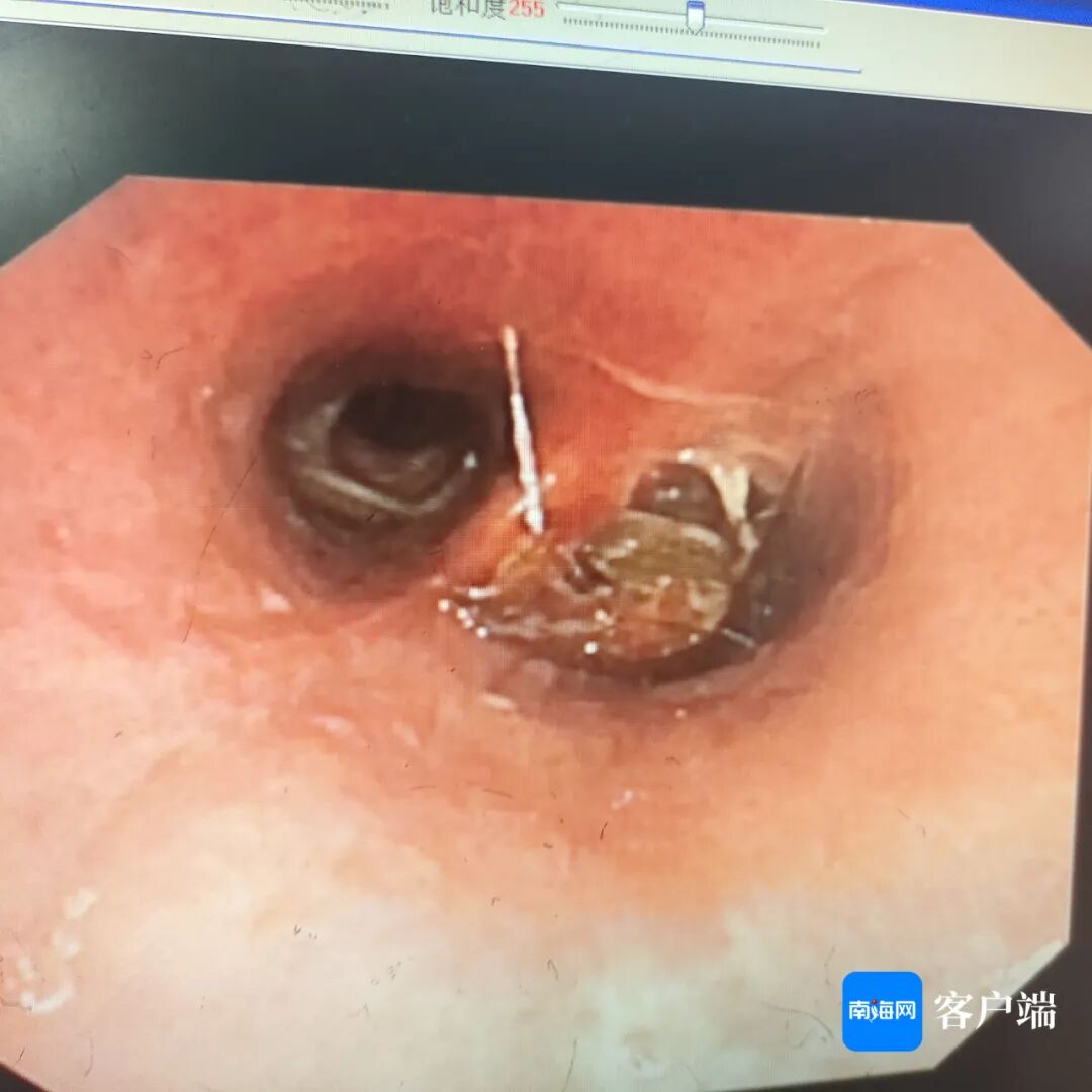 男子睡梦中蟑螂从鼻孔呛进气管，医生提醒