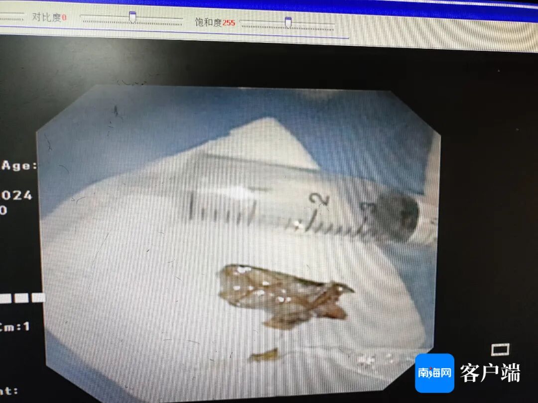 男子睡梦中蟑螂从鼻孔呛进气管，医生提醒