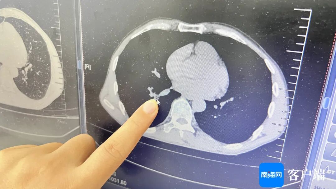 男子睡梦中蟑螂从鼻孔呛进气管，医生提醒