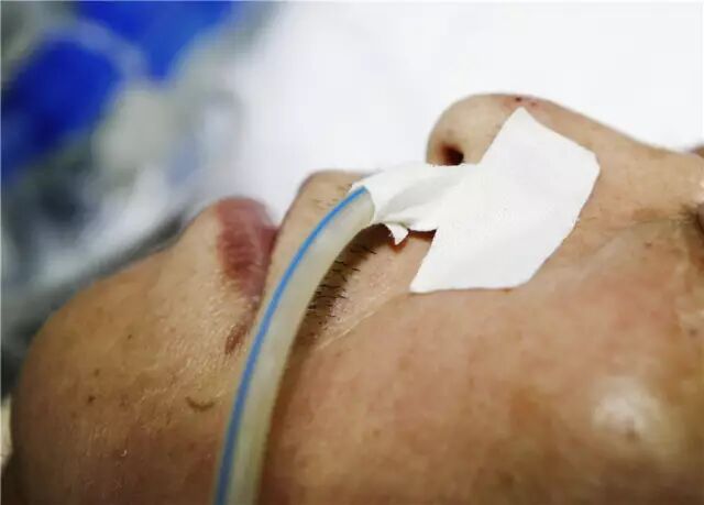 留置胃管鼻贴怎么贴留置胃管鼻贴花式贴法有T型、L型、P型...你用的是哪种？_https://www.jmylbn.com_新闻资讯_第3张