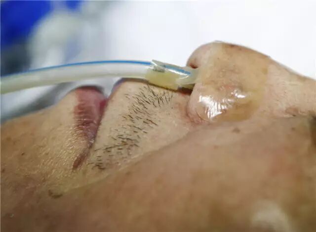 留置胃管鼻贴怎么贴留置胃管鼻贴花式贴法有T型、L型、P型...你用的是哪种？_https://www.jmylbn.com_新闻资讯_第11张