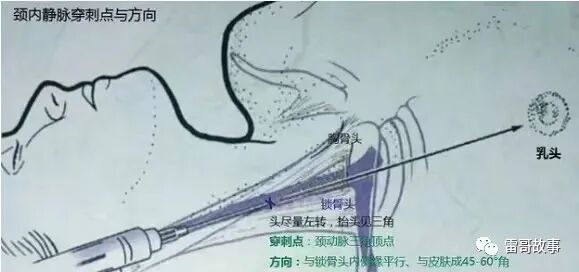 导丝怎么扩颈内静脉穿刺置管的临床经验_https://www.jmylbn.com_新闻资讯_第4张