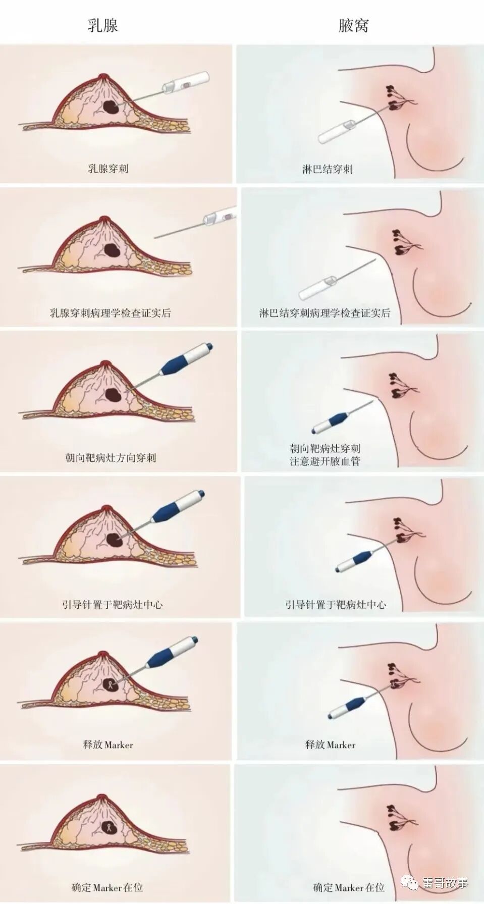 为什么要定位针 乳腺乳腺手术的定位导丝和标记夹的注意事项_https://www.jmylbn.com_新闻资讯_第2张