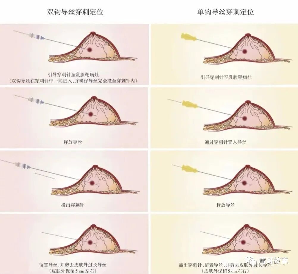 为什么要定位针 乳腺乳腺手术的定位导丝和标记夹的注意事项_https://www.jmylbn.com_新闻资讯_第1张