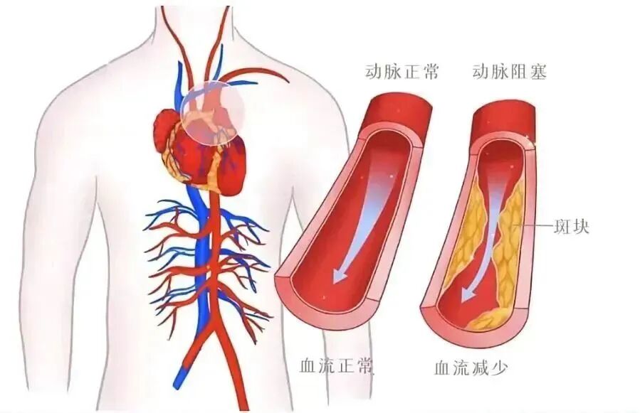 动脉硬化检测仪怎么用健康查体 — 动脉硬化检测仪，轻松五分钟测出血管健康指数_https://www.jmylbn.com_新闻资讯_第3张
