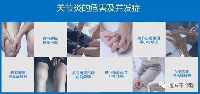 膝骨关节炎并发症