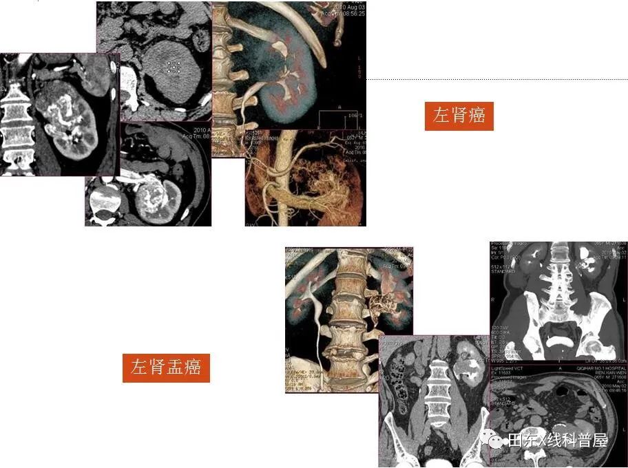 【走近影像】ct检查小科普，什么是ctu？