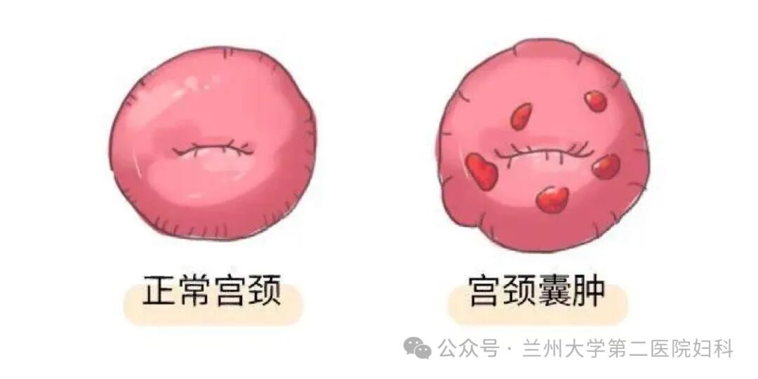 宫颈纳氏囊肿是什么？是否需要治疗？详解成因与处理方法
