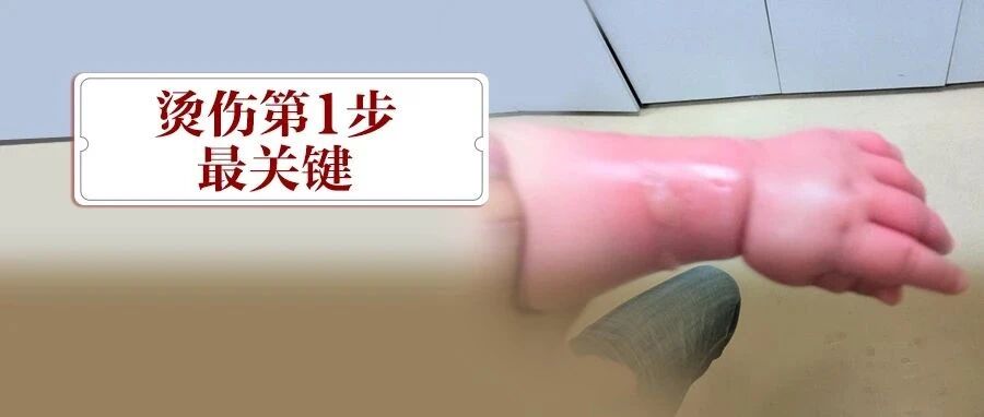 4岁娃烫伤，奶奶1个举动却害了他！这5字急救法，全家都要学会！