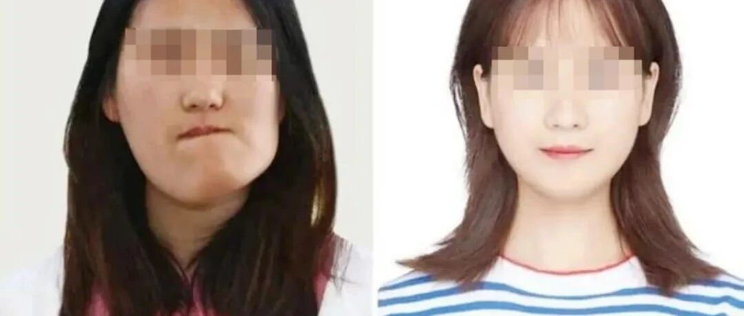 医学奇迹？“歪脸女孩”引发医学专家六大质疑！