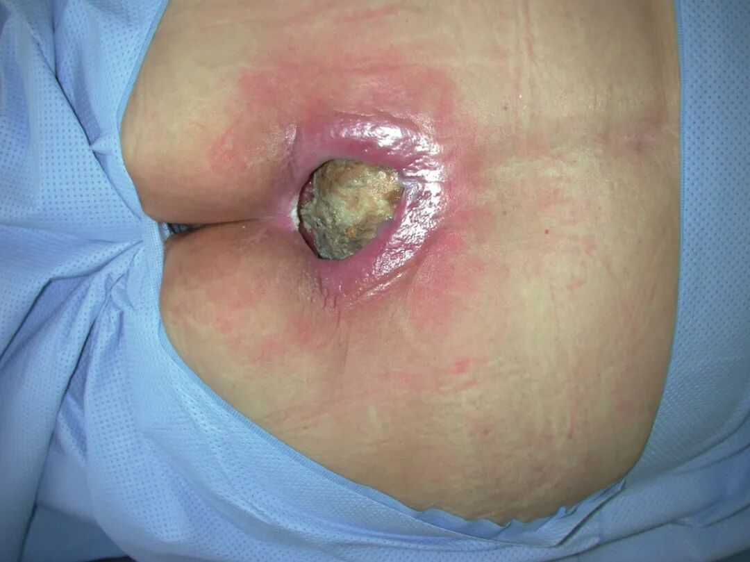 什么是压力治疗【指南】《2019 版《压疮 ／压力性损伤的预防和治疗： 临床实践指南》解读》——压力性损伤预防和治疗的共同措施_https://www.jmylbn.com_新闻资讯_第1张