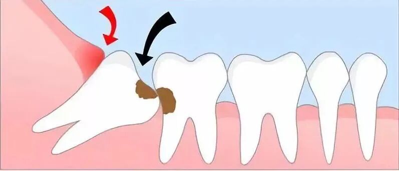 牙科怎么治疗智齿到底是留还是拔？拔智齿会痛吗？口腔舒适化治疗让你远离“看牙恐惧症”_https://www.jmylbn.com_新闻资讯_第2张