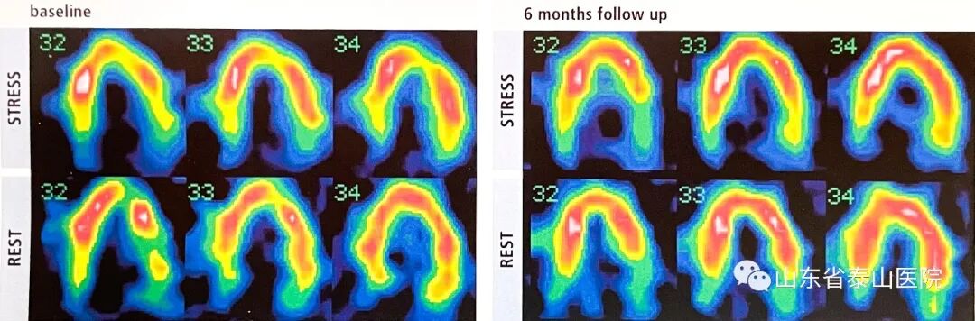 泰医医疗怎么样可优化微循环、避免严重或猝死事件发生：省泰医“体外心脏震波治疗中心”心血管再生疗法广受赞誉_https://www.jmylbn.com_新闻资讯_第9张
