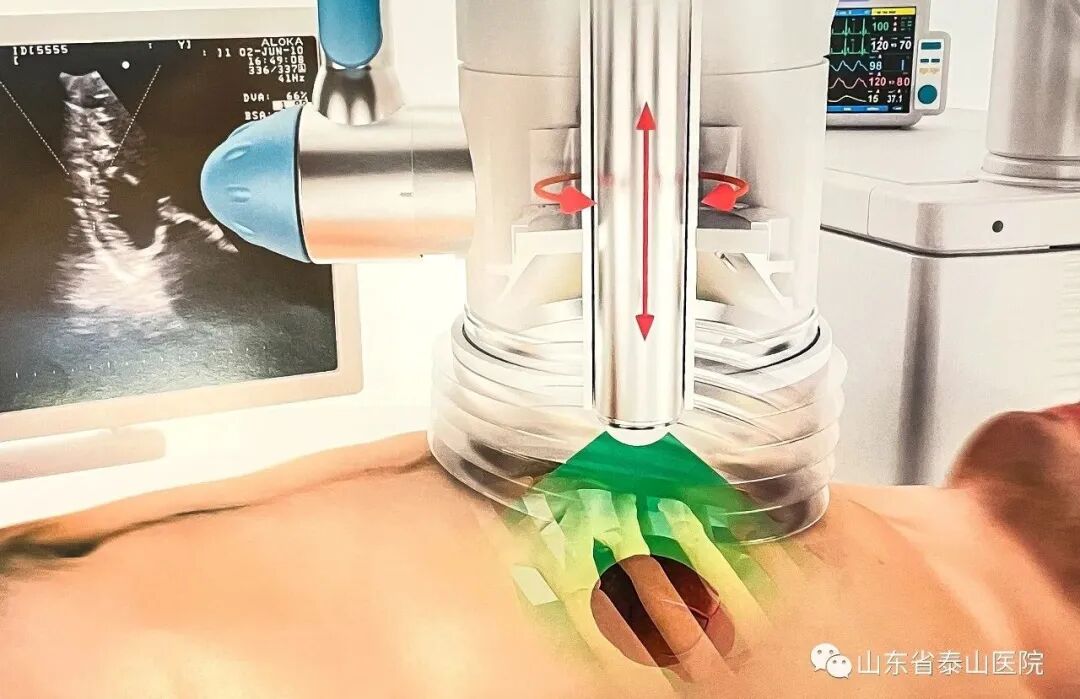 泰医医疗怎么样可优化微循环、避免严重或猝死事件发生：省泰医“体外心脏震波治疗中心”心血管再生疗法广受赞誉_https://www.jmylbn.com_新闻资讯_第4张