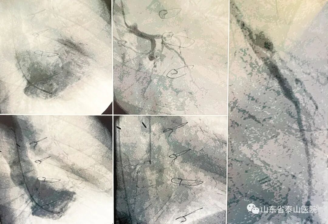 泰医医疗怎么样可优化微循环、避免严重或猝死事件发生：省泰医“体外心脏震波治疗中心”心血管再生疗法广受赞誉_https://www.jmylbn.com_新闻资讯_第10张