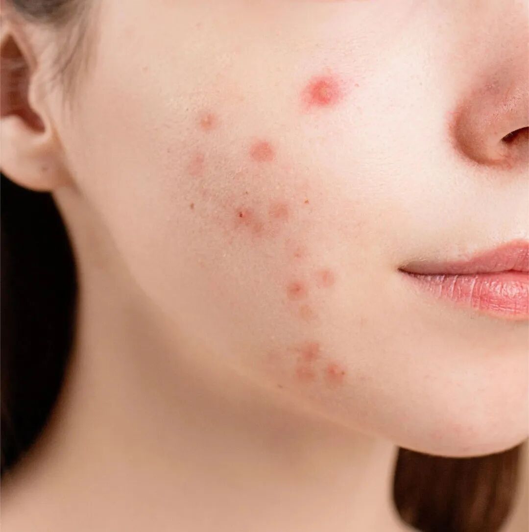 泰医医疗怎么样痤疮疱疹患者的福音——省泰医皮肤科引进“红蓝光治疗新利器” 多手段助力患者祛顽疾_https://www.jmylbn.com_新闻资讯_第4张