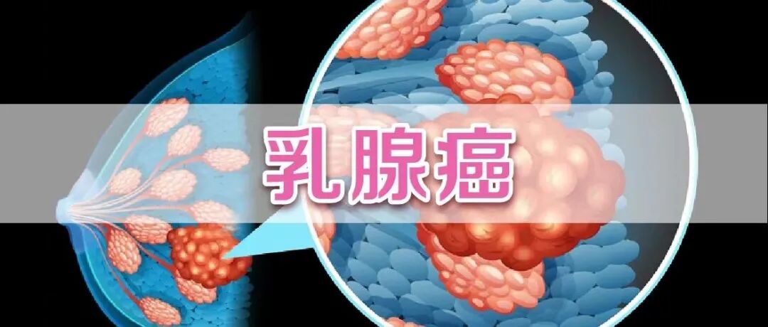 乳腺机为什么叫钼靶乳腺超声、乳腺钼靶、乳腺磁共振（MRI）有什么区别？该如何选择？_https://www.jmylbn.com_新闻资讯_第3张
