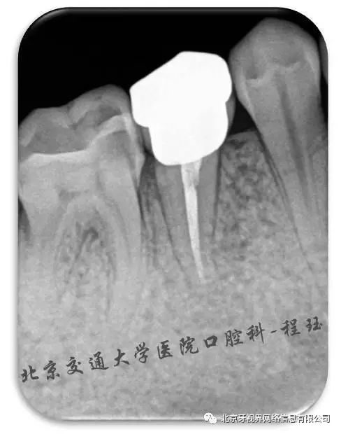 根管大赛参赛病例—右下第一磨牙根管治疗术 高嵌体冠修复1例 作者