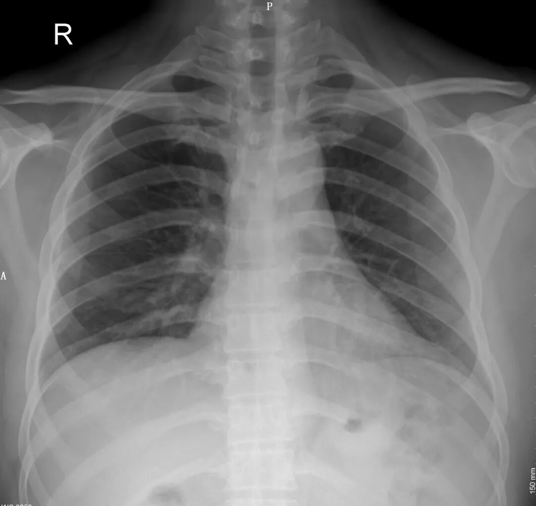 X光拍片为什么要等科普｜拍胸片检查时，为什么要求女性脱掉衣服_https://www.jmylbn.com_新闻资讯_第5张