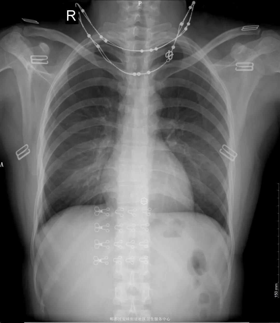 X光拍片为什么要等科普｜拍胸片检查时，为什么要求女性脱掉衣服_https://www.jmylbn.com_新闻资讯_第6张