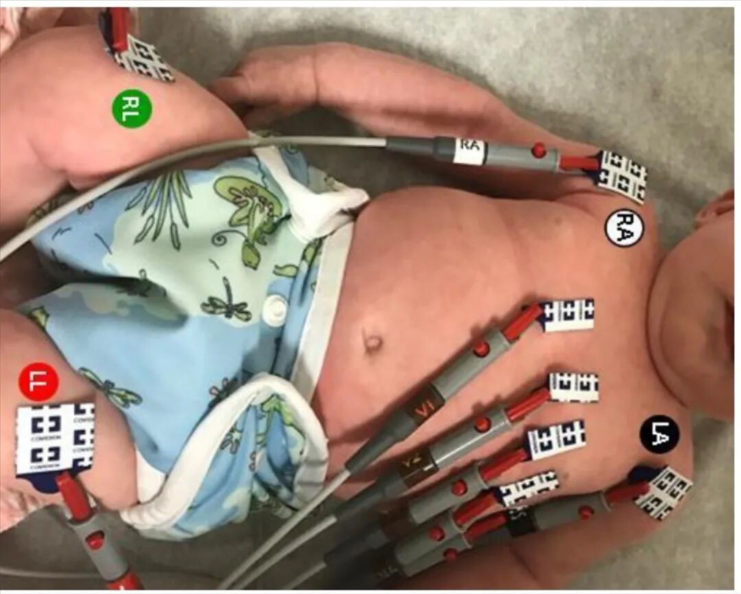 心电图12导怎么组成儿童心电图操作（常规12导联）_https://www.jmylbn.com_新闻资讯_第20张