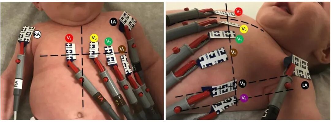 心电图12导怎么组成儿童心电图操作（常规12导联）_https://www.jmylbn.com_新闻资讯_第19张