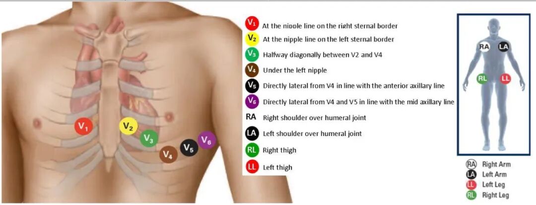 心电图12导怎么组成儿童心电图操作（常规12导联）_https://www.jmylbn.com_新闻资讯_第18张
