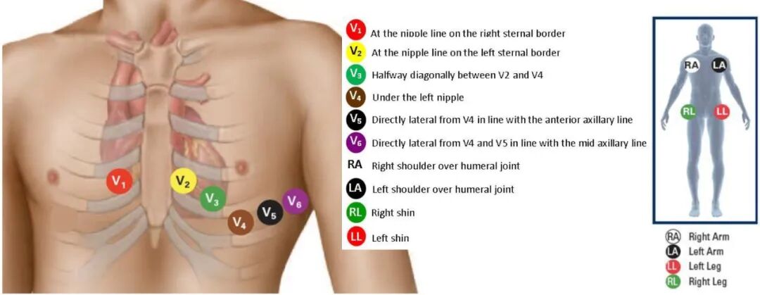 心电图12导怎么组成儿童心电图操作（常规12导联）_https://www.jmylbn.com_新闻资讯_第10张