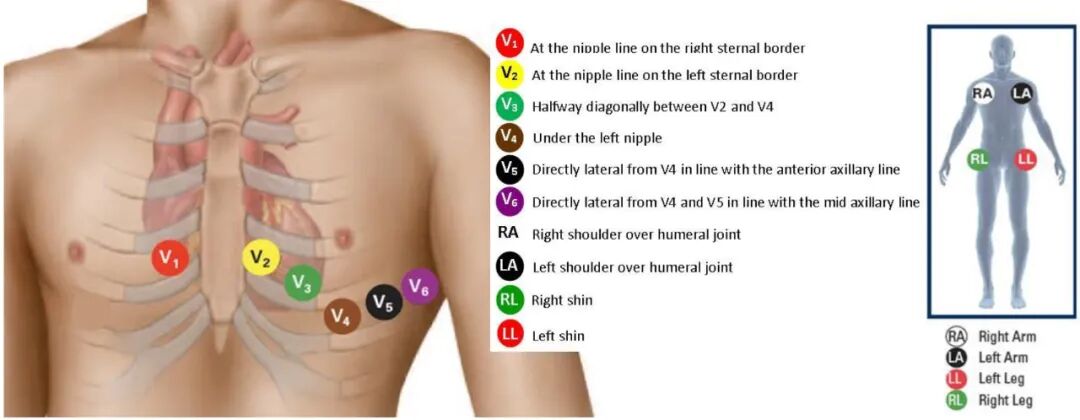 心电图12导怎么组成儿童心电图操作（常规12导联）_https://www.jmylbn.com_新闻资讯_第13张
