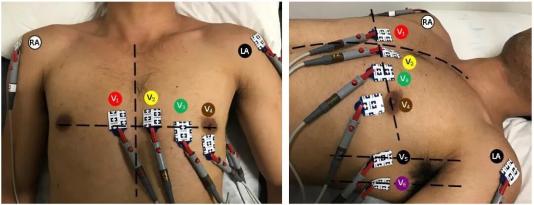 心电图12导怎么组成儿童心电图操作（常规12导联）_https://www.jmylbn.com_新闻资讯_第11张