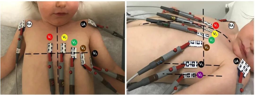 心电图12导怎么组成儿童心电图操作（常规12导联）_https://www.jmylbn.com_新闻资讯_第14张