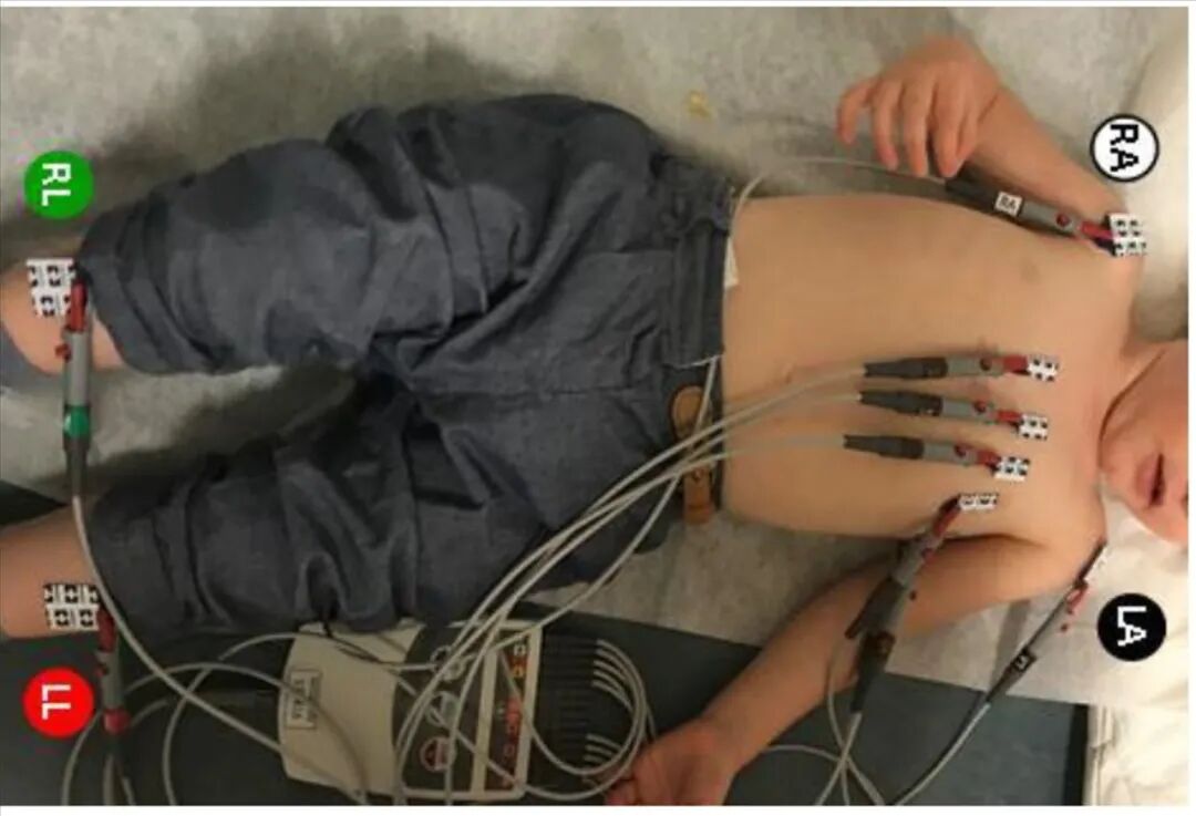 心电图12导怎么组成儿童心电图操作（常规12导联）_https://www.jmylbn.com_新闻资讯_第15张