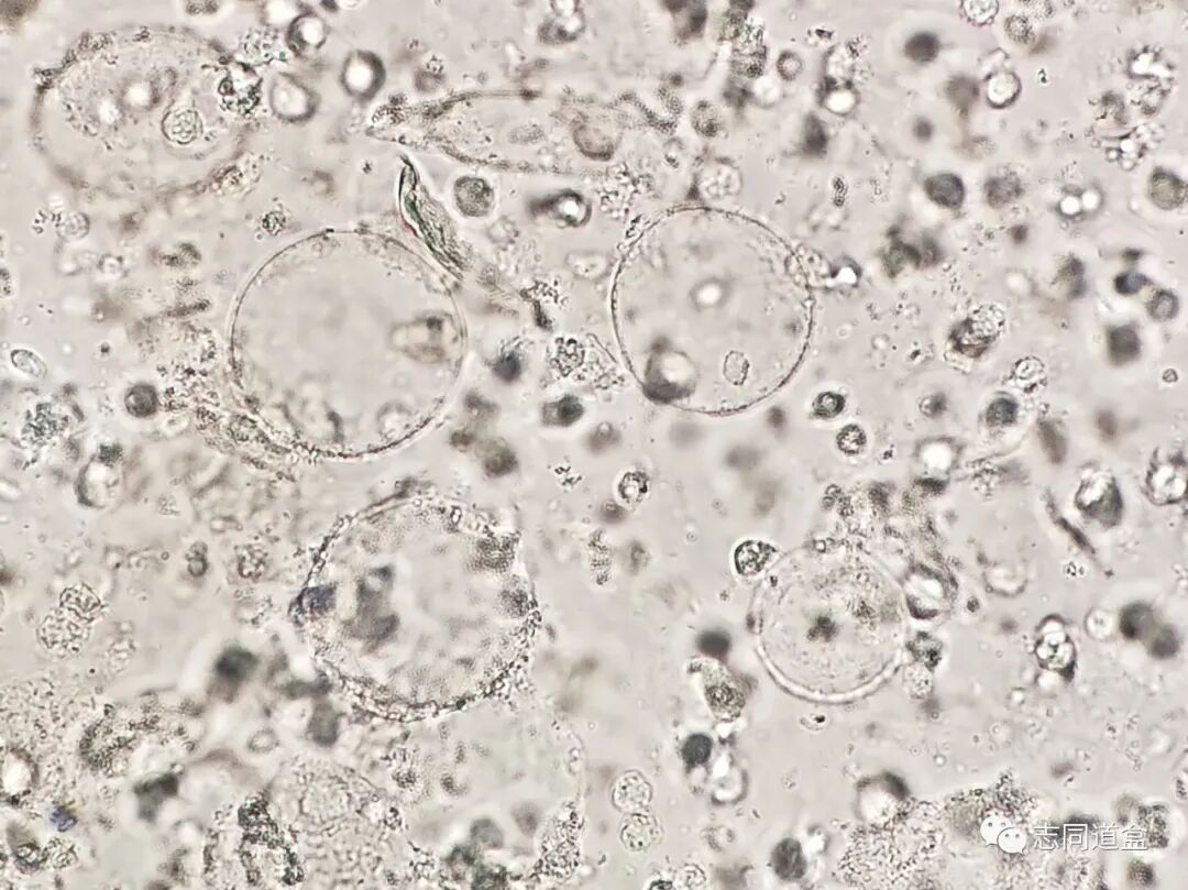 上皮细胞用什么染色尿液发现大量空泡，到底是什么？_https://www.jmylbn.com_新闻资讯_第3张