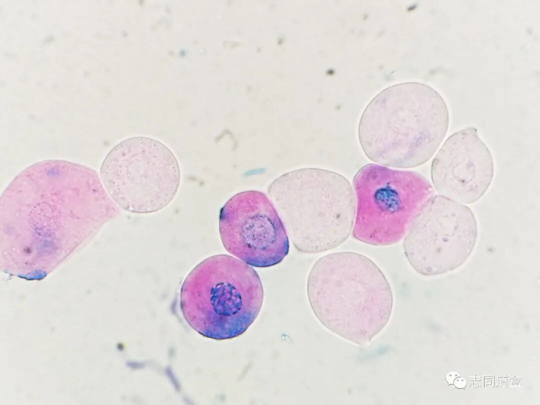 上皮细胞用什么染色尿液发现大量空泡，到底是什么？_https://www.jmylbn.com_新闻资讯_第11张