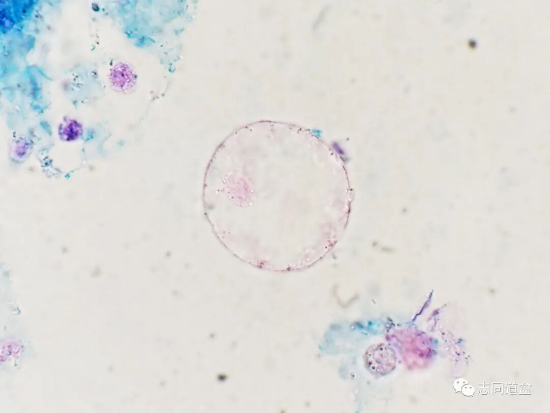 上皮细胞用什么染色尿液发现大量空泡，到底是什么？_https://www.jmylbn.com_新闻资讯_第5张