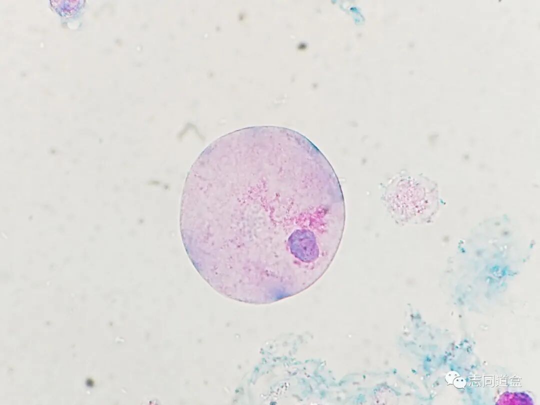 上皮细胞用什么染色尿液发现大量空泡，到底是什么？_https://www.jmylbn.com_新闻资讯_第7张