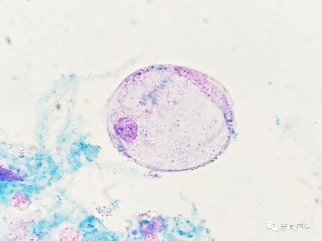 上皮细胞用什么染色尿液发现大量空泡，到底是什么？_https://www.jmylbn.com_新闻资讯_第8张