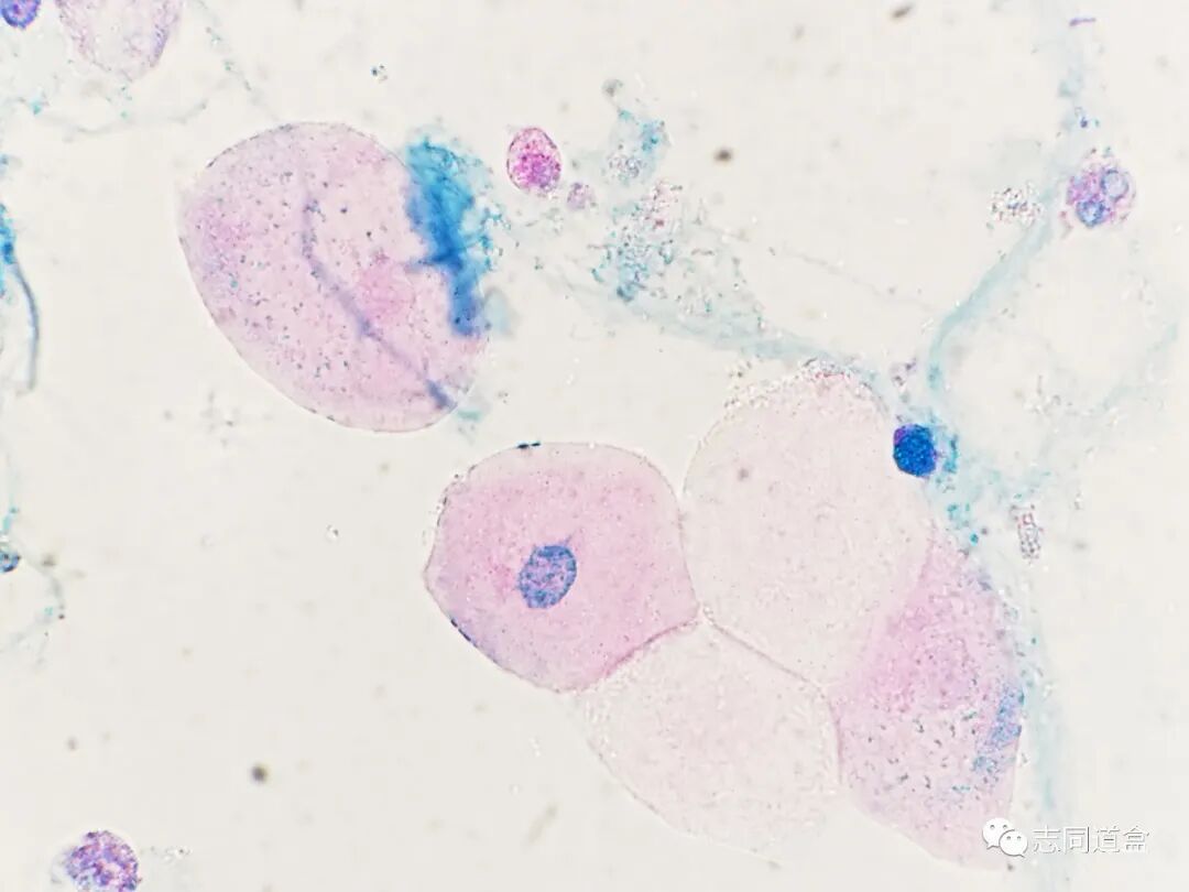 上皮细胞用什么染色尿液发现大量空泡，到底是什么？_https://www.jmylbn.com_新闻资讯_第10张