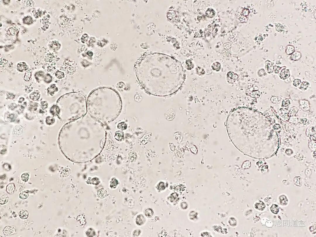 上皮细胞用什么染色尿液发现大量空泡，到底是什么？_https://www.jmylbn.com_新闻资讯_第4张