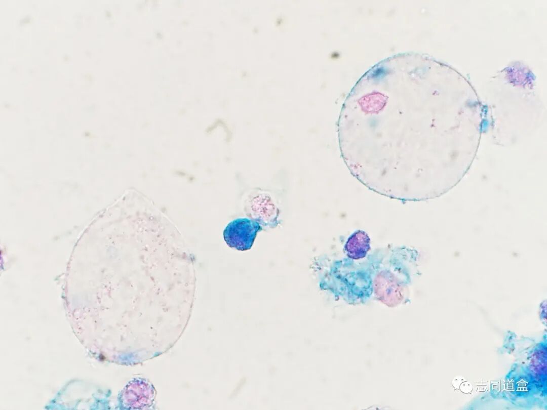 上皮细胞用什么染色尿液发现大量空泡，到底是什么？_https://www.jmylbn.com_新闻资讯_第9张