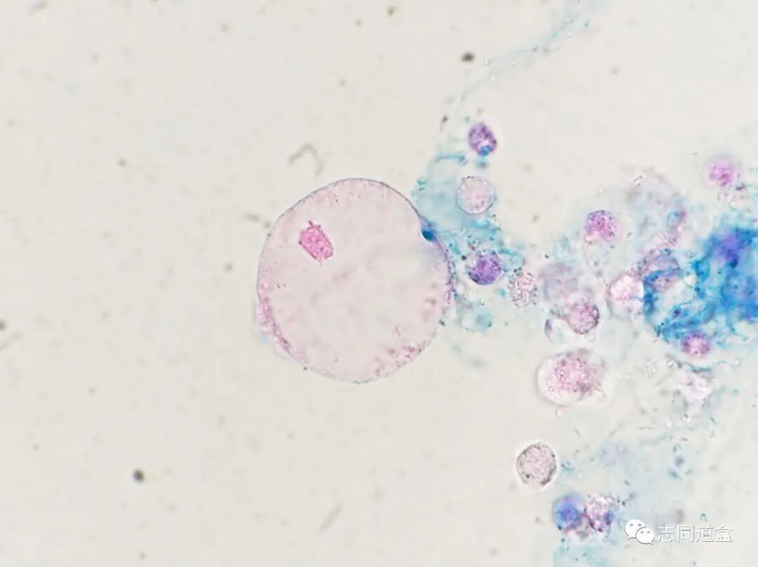 上皮细胞用什么染色尿液发现大量空泡，到底是什么？_https://www.jmylbn.com_新闻资讯_第6张