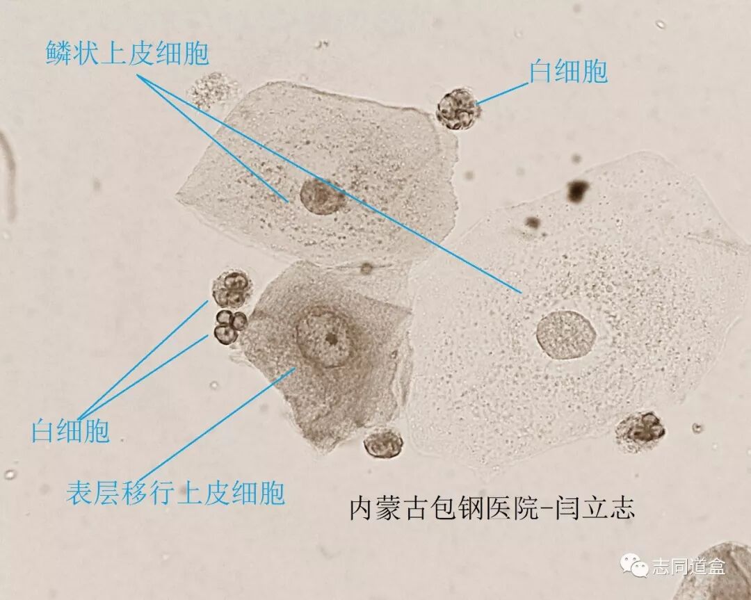 表层移行上皮细胞 志同道盒 微信公众号文章阅读 Wemp