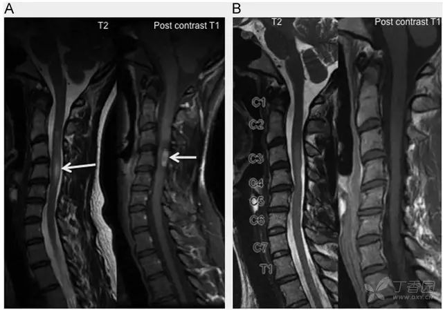 最全影像學總結 10種常見脊髓非腫瘤性病變 神經時間 微文庫