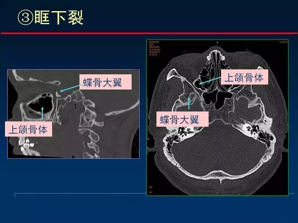 ct入門 | 翼顎窩ct解剖,收藏必備_醫學界-助力醫生臨床決策和職業成長