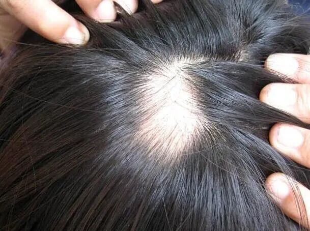 头发斑秃是什么原因引起的？可以治好吗？