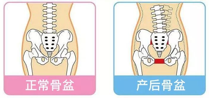 骨盆修复，让你的形体更迷人！