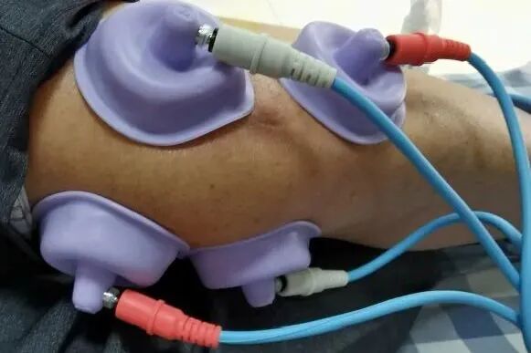 什么是中频干扰【物理治疗】中频治疗 “神器＂ ——干扰电_https://www.jmylbn.com_新闻资讯_第24张