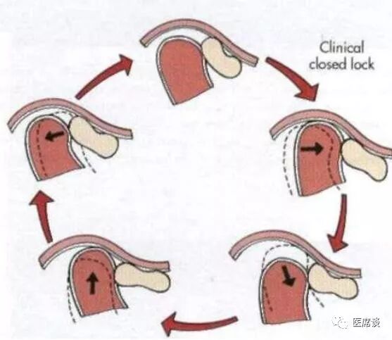 下面我们来看看每一类疾病的临床特点. 可复性关节盘前移位的特点