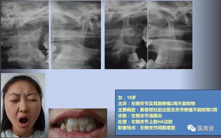 查体发现左侧关节区疼痛,闭口位左侧关节上间隙明显增宽,但是开口不