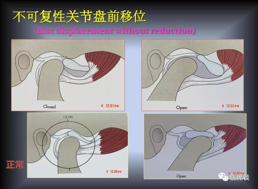 正常髁突图片